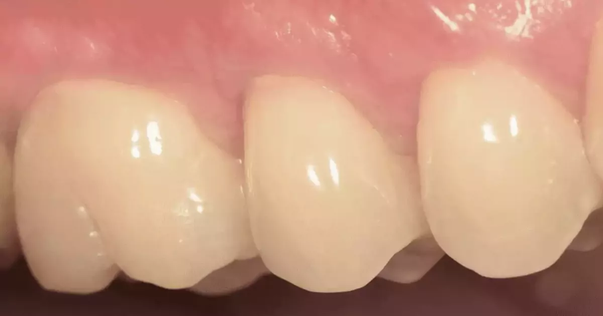 Cause denti scoperti e rimedi per il dolore