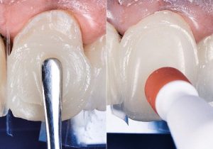 Cosa sono le faccette dentali