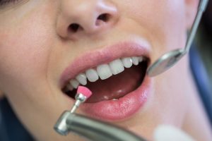 Quanto dura la pulizia dei denti
