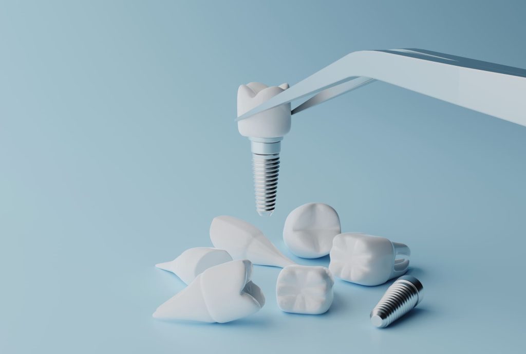 Scopri cosa fare prima di un impianto dentale