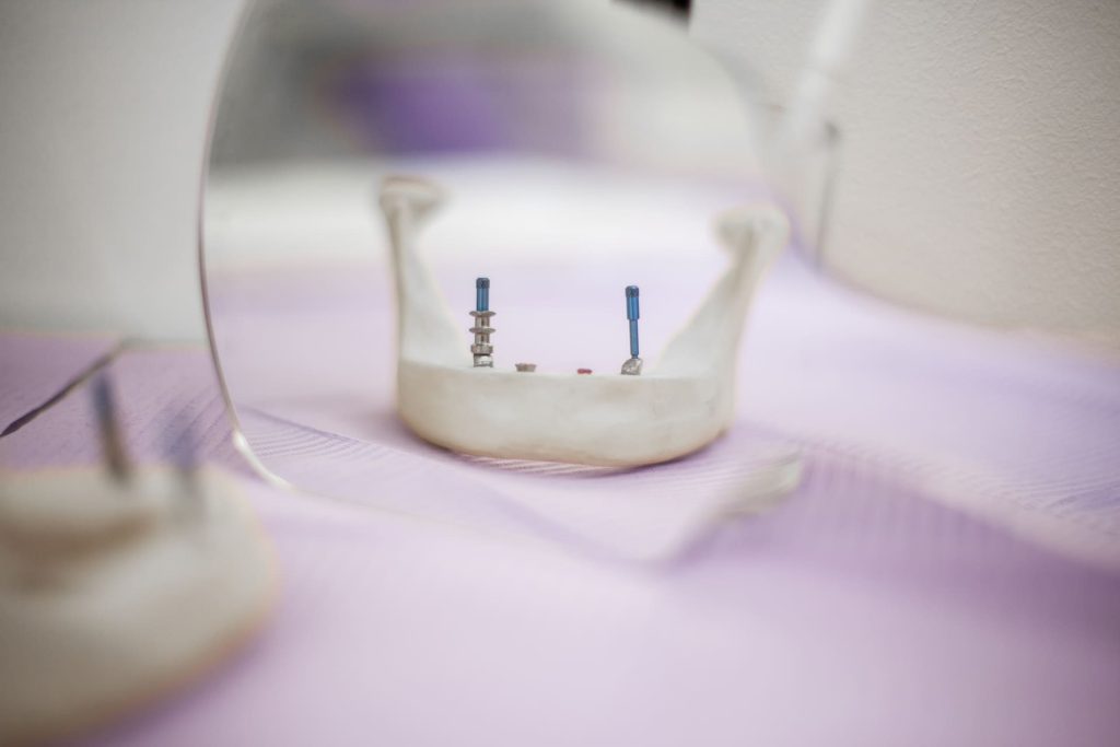 come funziona un impianto dentale