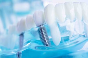 Quanto dura un impianto dentale