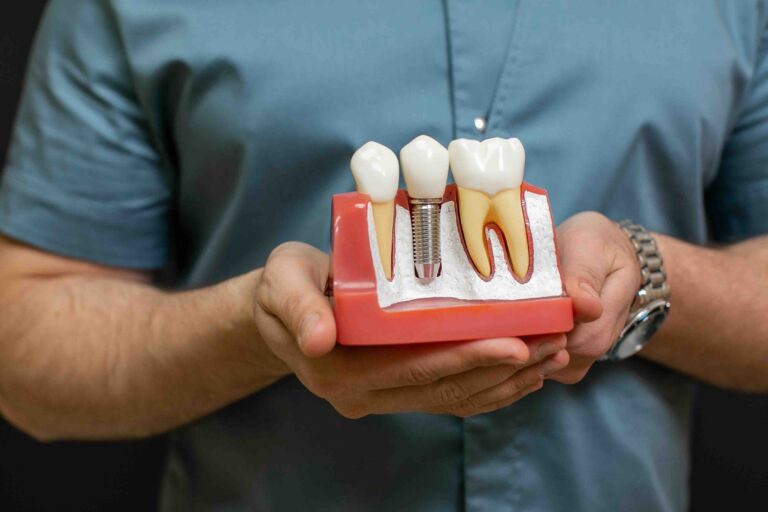 glossario implantologia dentale